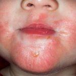Dermatitis atópica