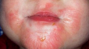 Dermatitis atópica