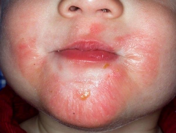 Dermatitis atópica